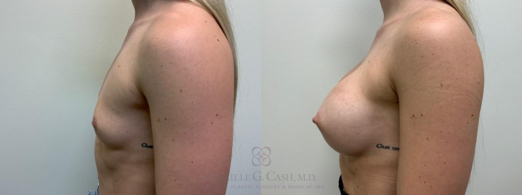 Before & After Breast Augmentation Case 479 Left Side View in Houston, TX