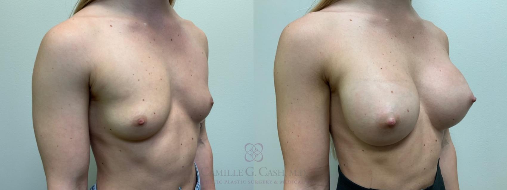 Before & After Breast Augmentation Case 479 Right Oblique View in Houston, TX