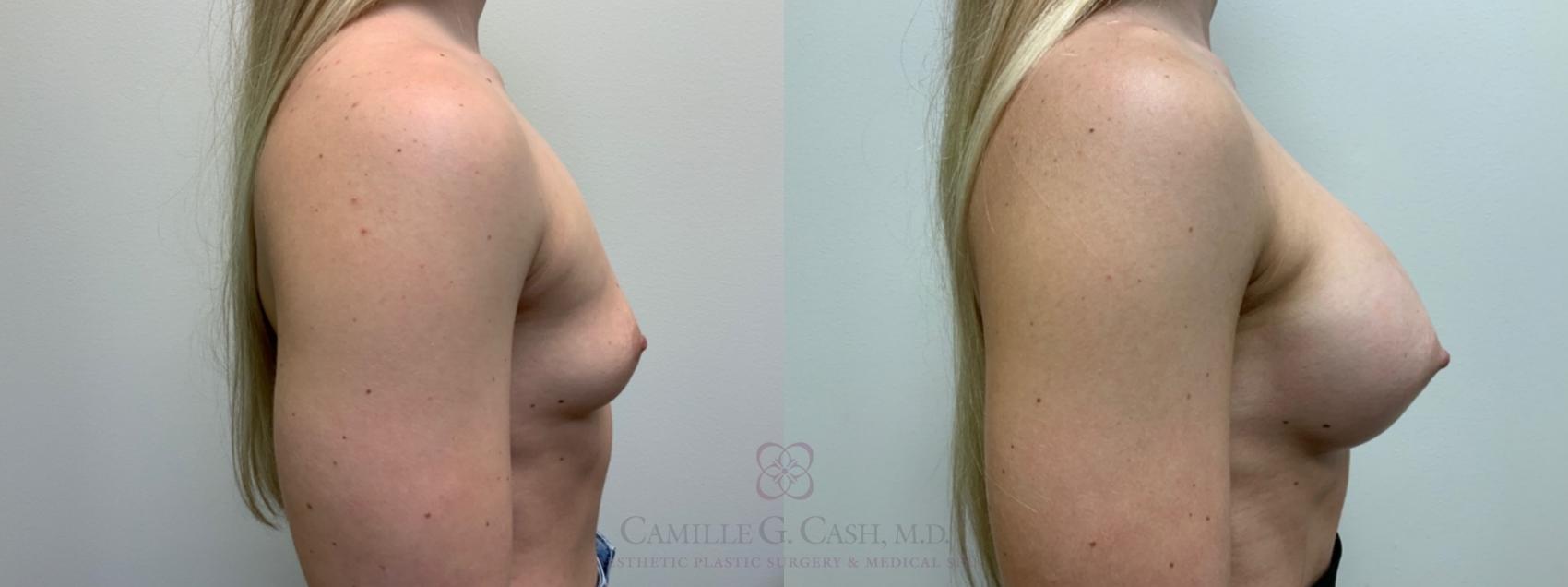 Before & After Breast Augmentation Case 479 Right Side View in Houston, TX