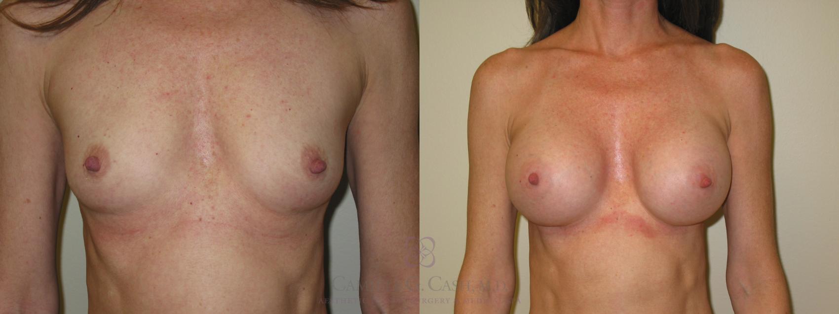 Before & After Breast Augmentation Case 48 View #1 View in Houston, TX