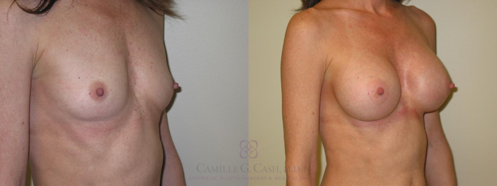 Before & After Breast Augmentation Case 48 View #2 View in Houston, TX