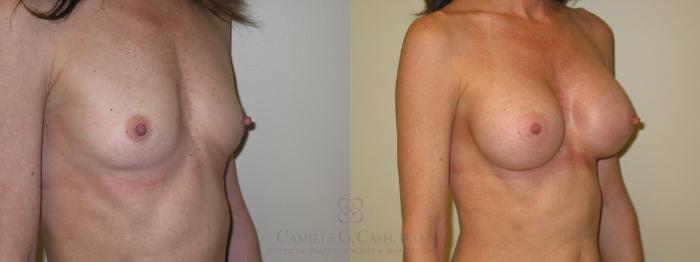 Before & After Breast Augmentation Case 48 View #2 View in Houston, TX