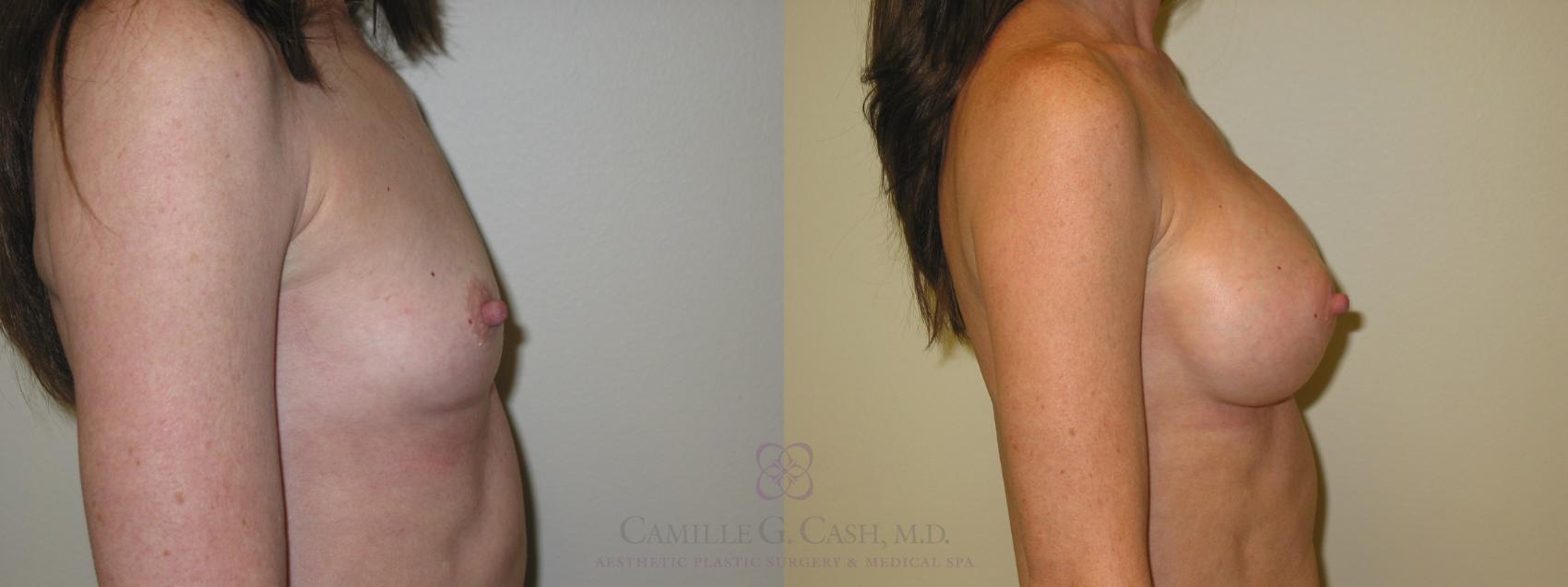 Before & After Breast Augmentation Case 48 View #3 View in Houston, TX