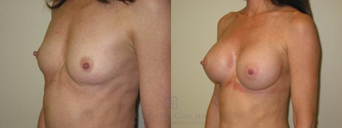 Before & After Breast Augmentation Case 48 View #4 View in Houston, TX