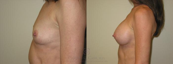 Before & After Breast Augmentation Case 48 View #5 View in Houston, TX