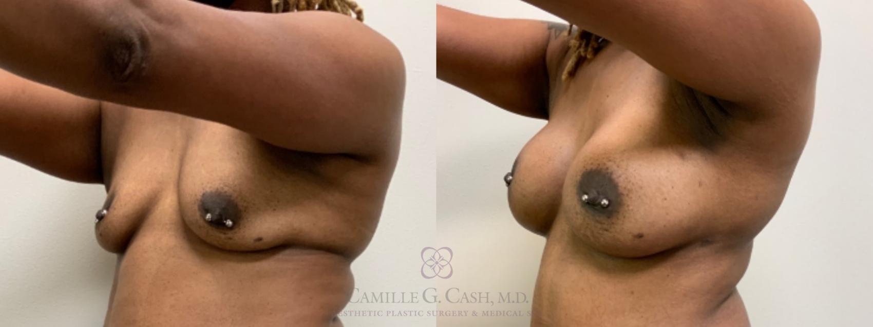 Before & After Breast Augmentation Case 504 Right Oblique View in Houston, TX