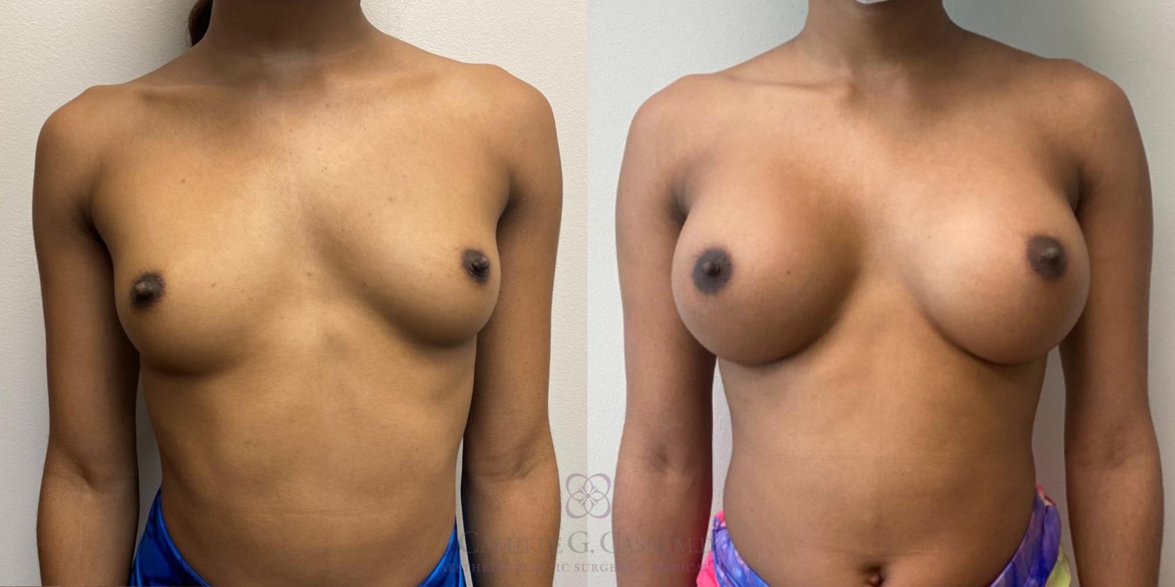 Before & After Breast Augmentation Case 505 Front View in Houston, TX