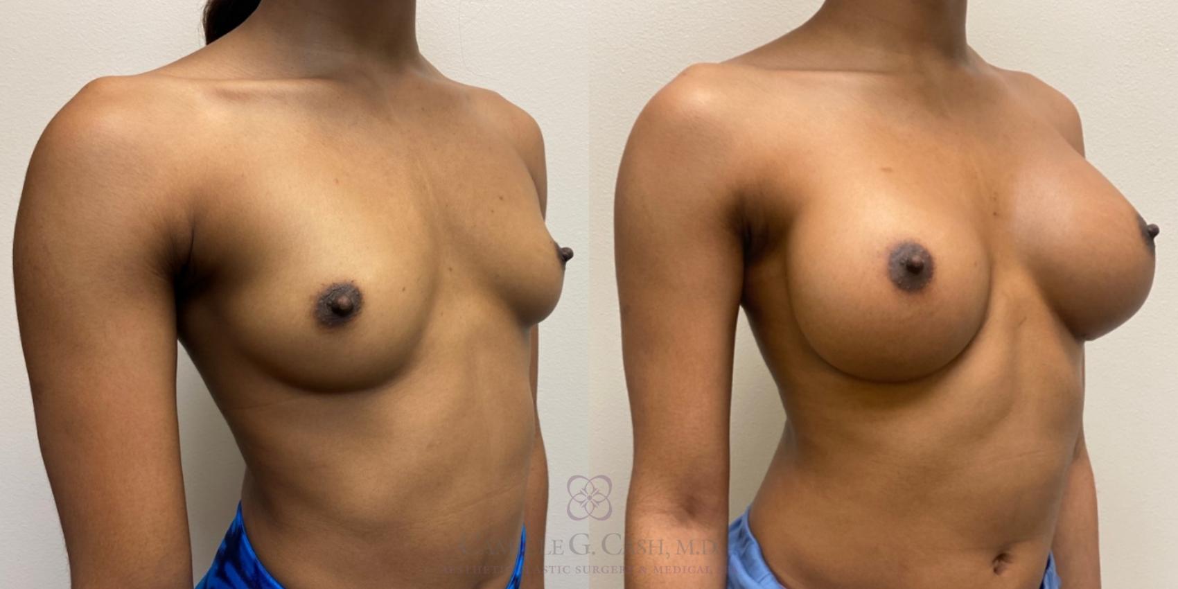 Before & After Breast Augmentation Case 505 Left Oblique View in Houston, TX