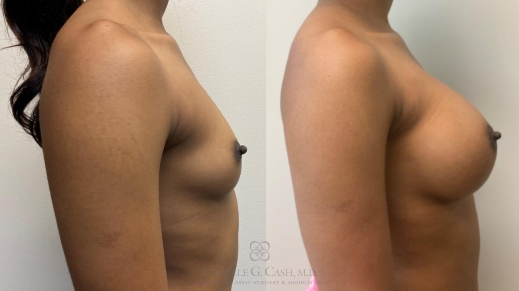 Before & After Breast Augmentation Case 505 Left Side View in Houston, TX