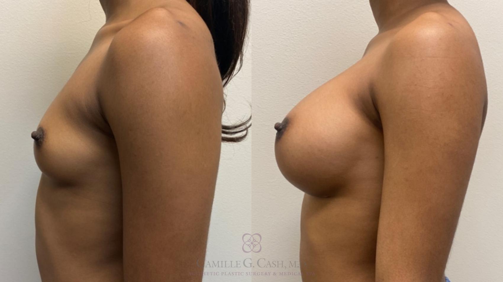 Before & After Breast Augmentation Case 505 Right Side View in Houston, TX
