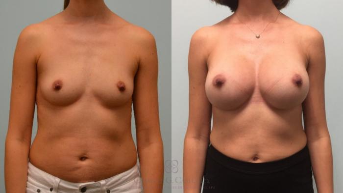 Before & After Breast Augmentation Case 511 Front View in Houston, TX