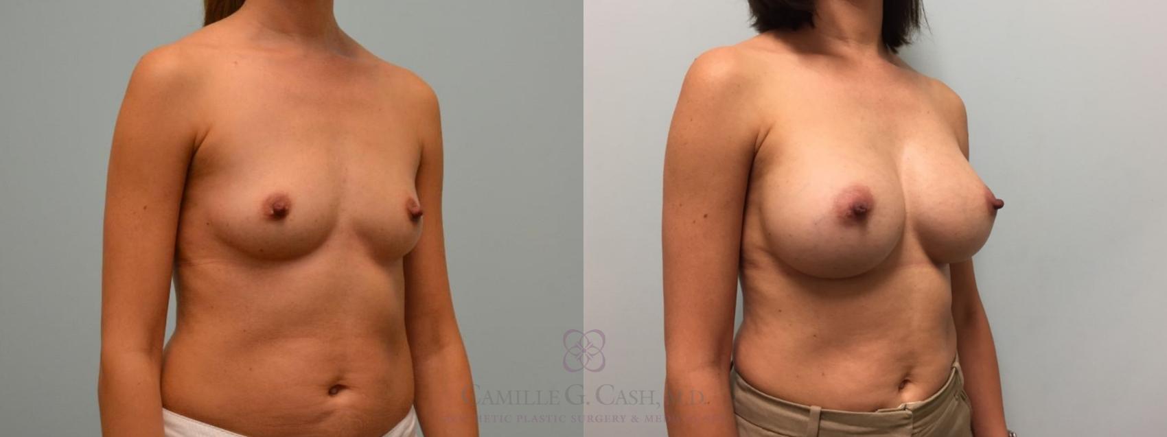 Before & After Breast Augmentation Case 511 Left Oblique View in Houston, TX