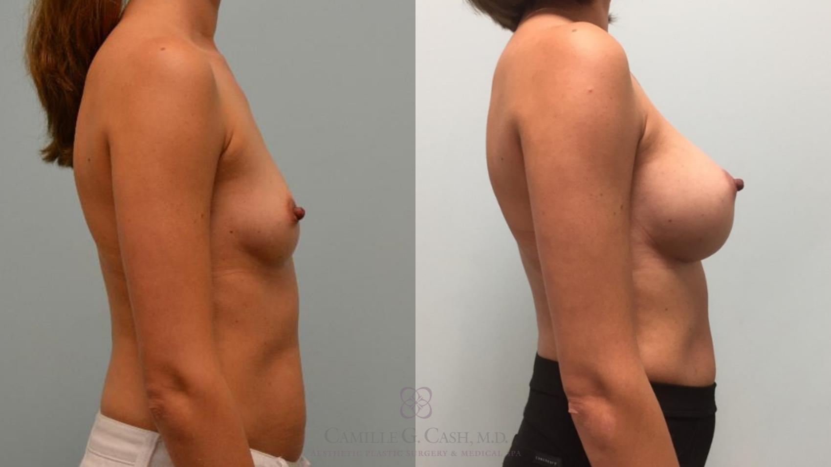 Before & After Breast Augmentation Case 511 Left Side View in Houston, TX