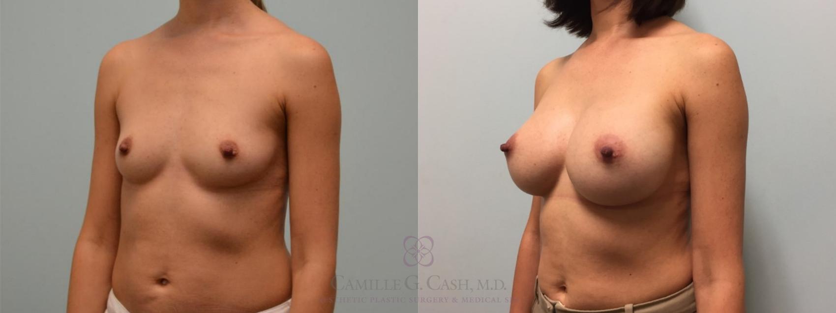 Before & After Breast Augmentation Case 511 Right Oblique View in Houston, TX