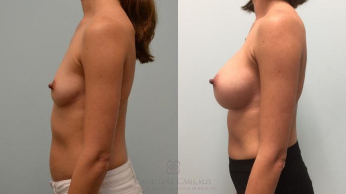 Before & After Breast Augmentation Case 511 Right Side View in Houston, TX