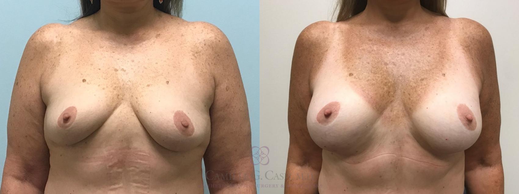 Before & After Breast Augmentation Case 516 Front View in Houston, TX