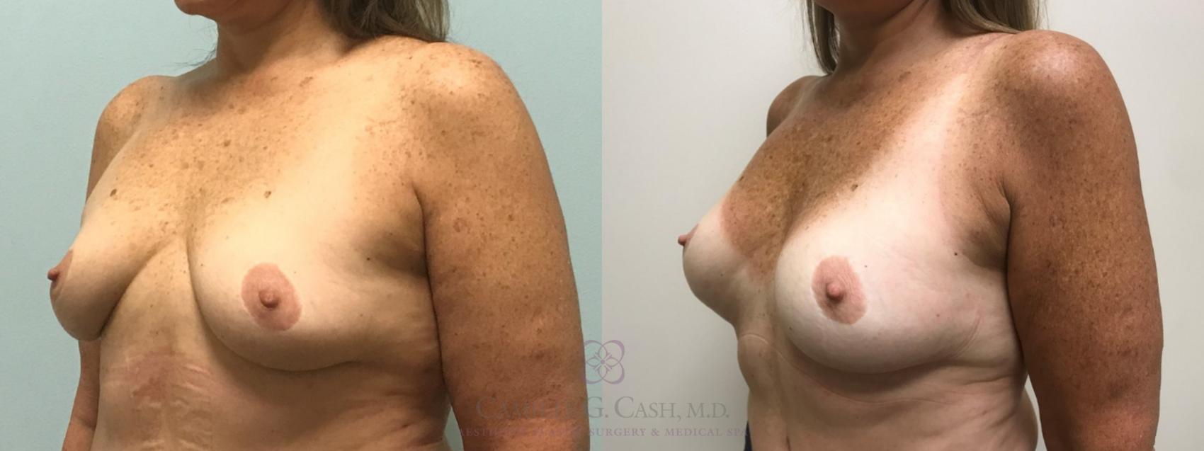 Before & After Breast Augmentation Case 516 Left Oblique View in Houston, TX