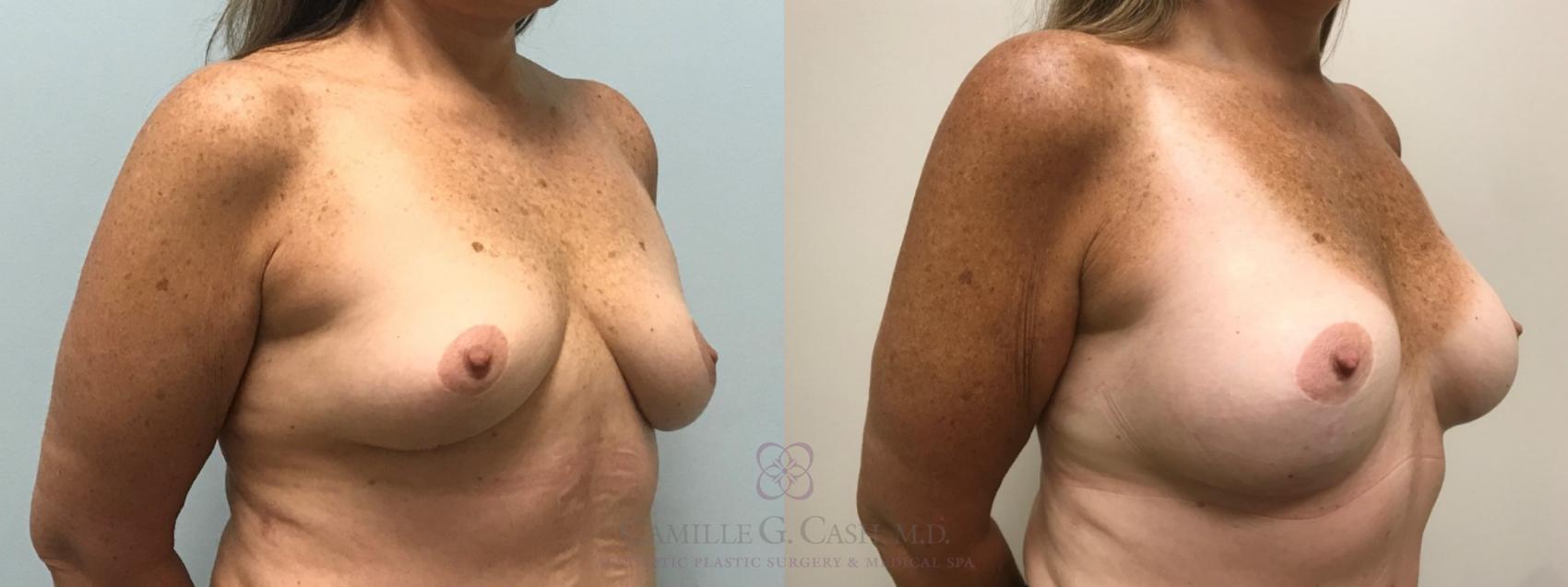 Before & After Breast Augmentation Case 516 Right Oblique View in Houston, TX