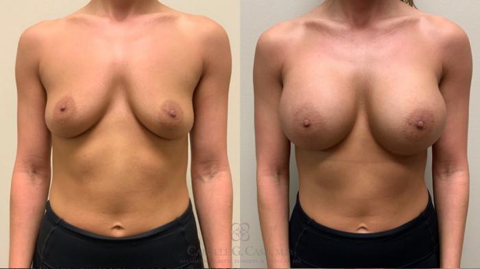 Before & After Breast Augmentation Case 532 Front View in Houston, TX