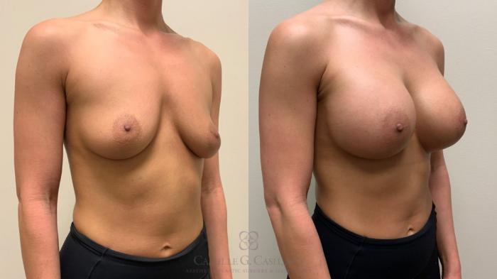 Before & After Breast Augmentation Case 532 Left Oblique View in Houston, TX