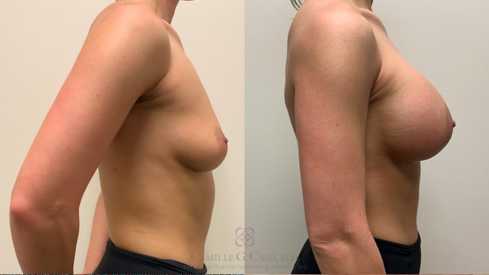 Before & After Breast Augmentation Case 532 Left Side View in Houston, TX