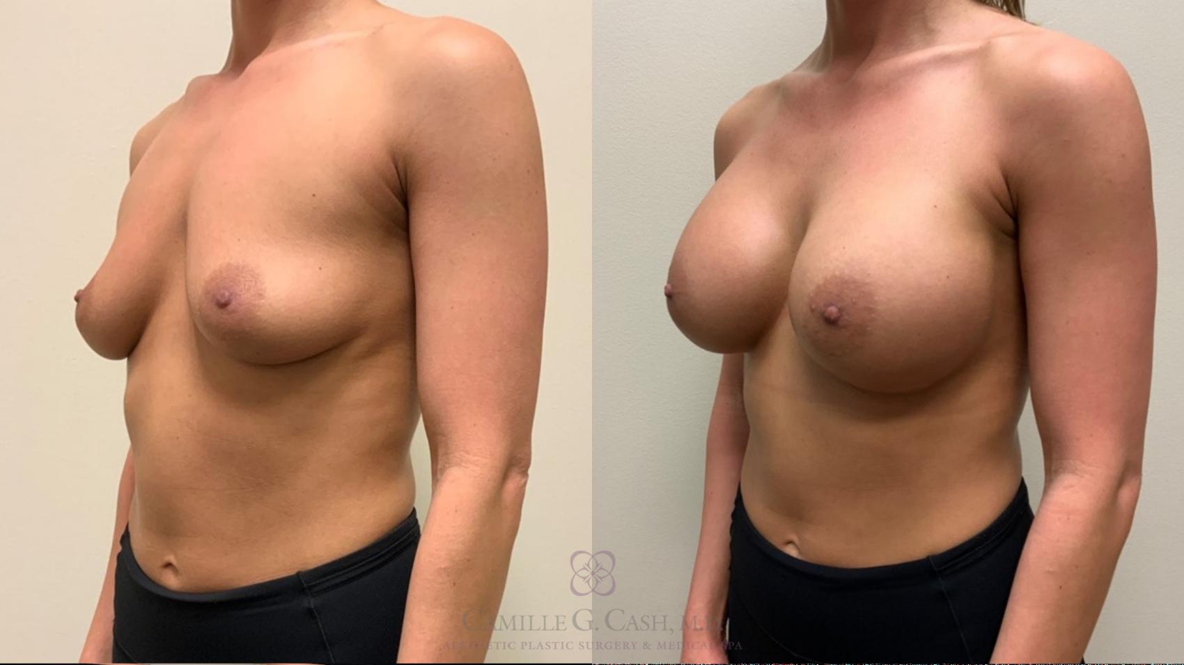 Before & After Breast Augmentation Case 532 Right Oblique View in Houston, TX