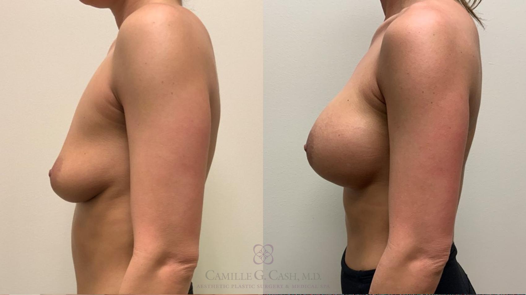 Before & After Breast Augmentation Case 532 Right Side View in Houston, TX