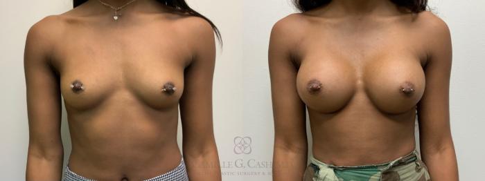 Before & After Breast Augmentation Case 537 Front View in Houston, TX
