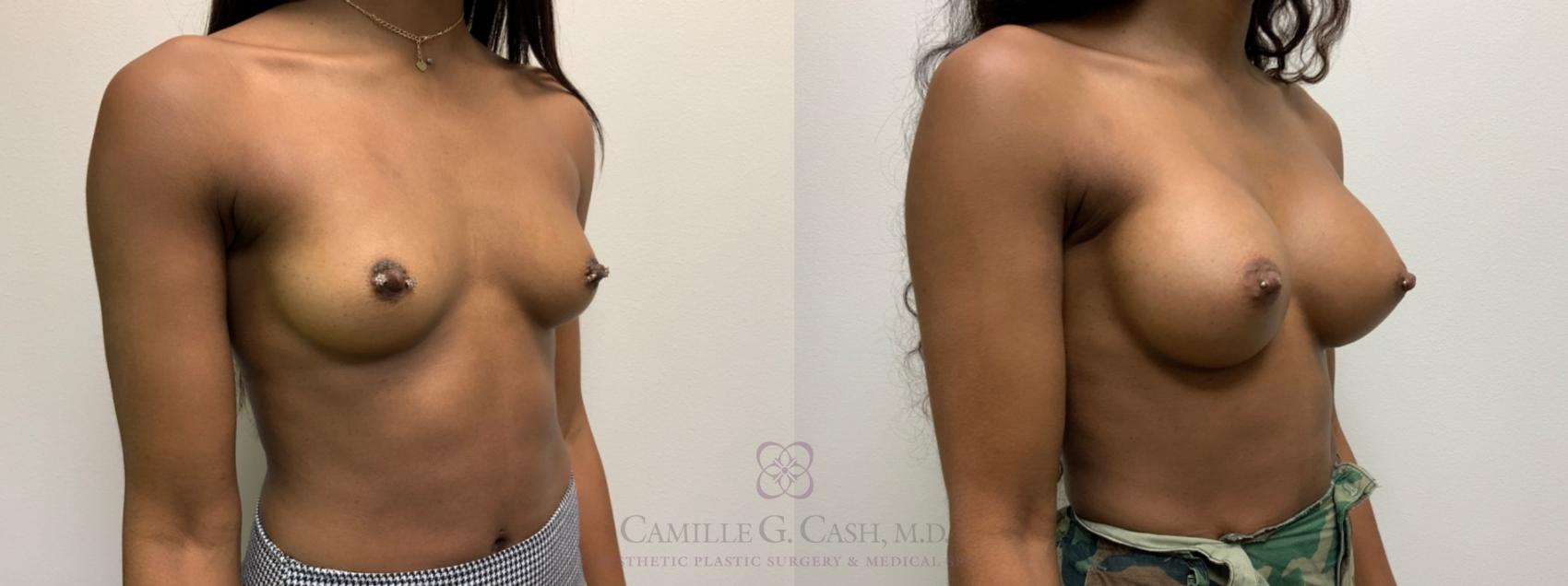 Before & After Breast Augmentation Case 537 Left Oblique View in Houston, TX