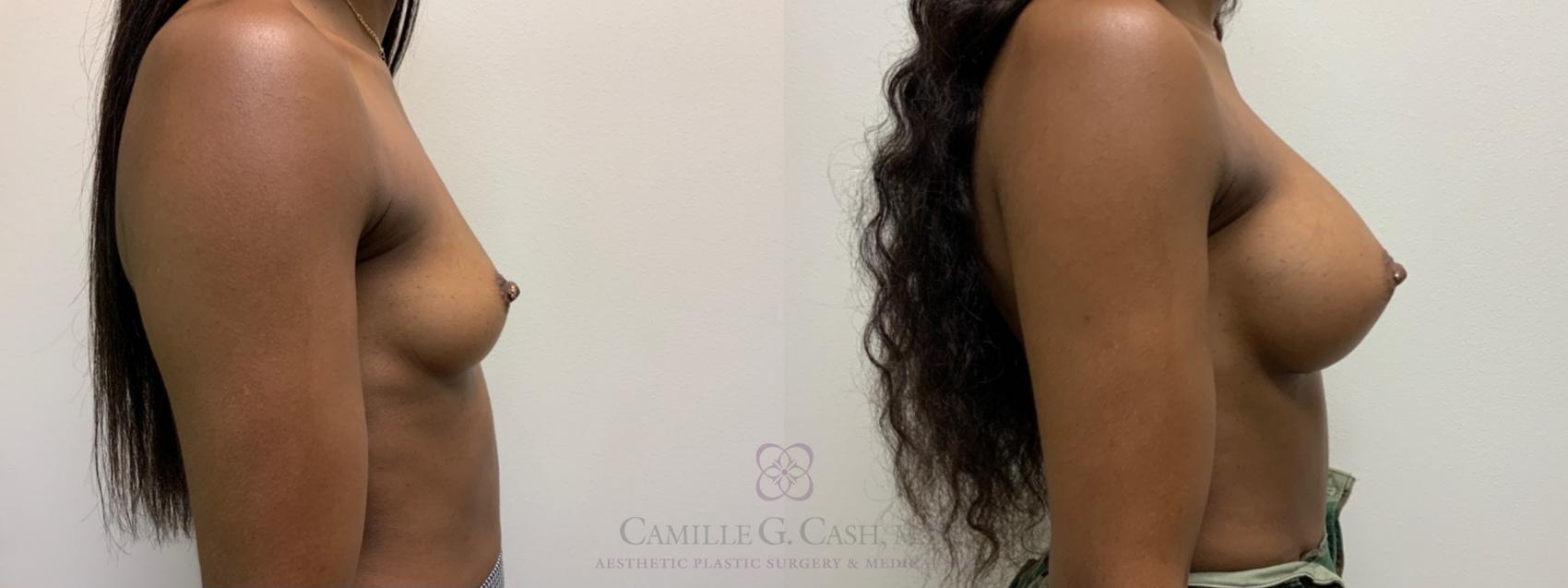 Before & After Breast Augmentation Case 537 Left Side View in Houston, TX