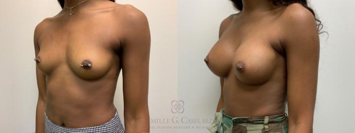 Before & After Breast Augmentation Case 537 Right Oblique View in Houston, TX