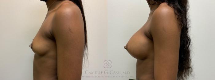 Before & After Breast Augmentation Case 537 Right Side View in Houston, TX