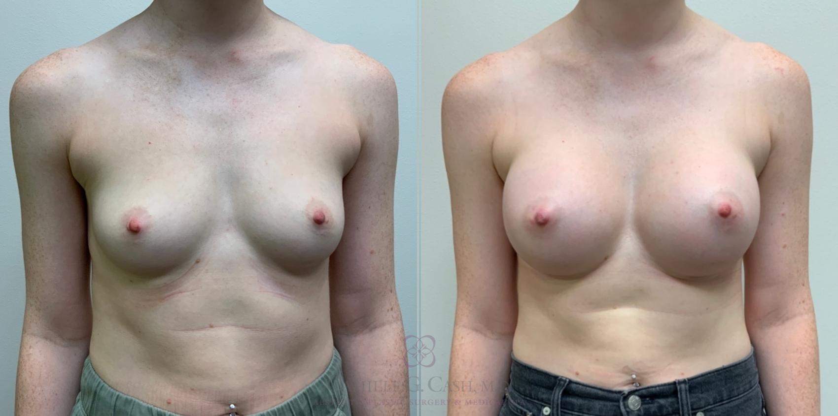 Before & After Breast Augmentation Case 543 front 2 View in Houston, TX
