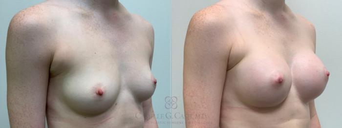 Before & After Breast Augmentation Case 543 Left Oblique View in Houston, TX