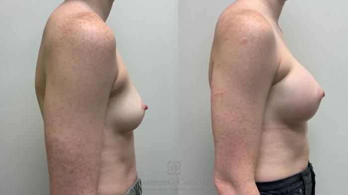 Before & After Breast Augmentation Case 543 Left Side View in Houston, TX