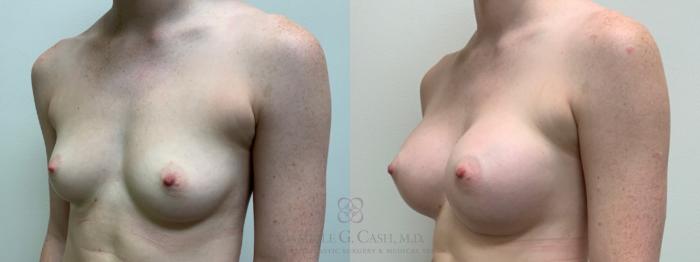 Before & After Breast Augmentation Case 543 Right Oblique View in Houston, TX