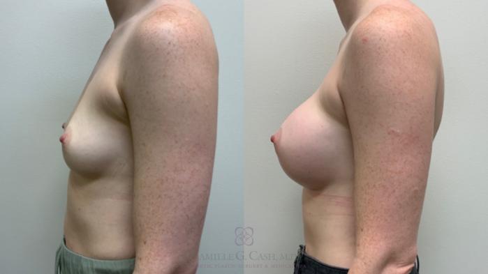 Before & After Breast Augmentation Case 543 Right Side View in Houston, TX