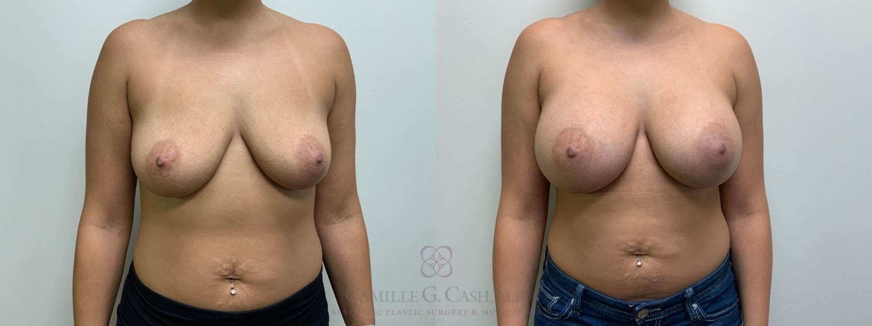 Before & After Breast Augmentation Case 553 Front View in Houston, TX