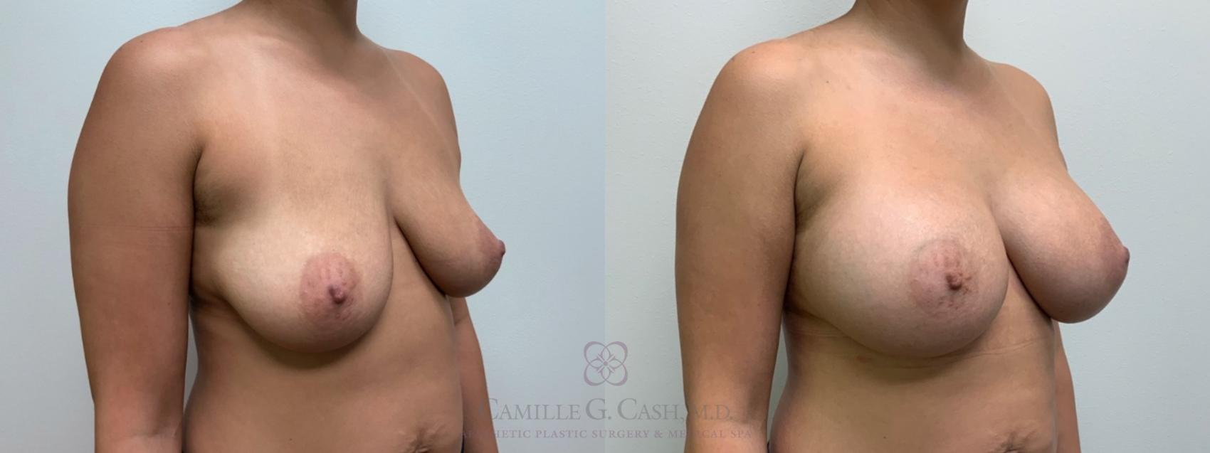 Before & After Breast Augmentation Case 553 Left Oblique View in Houston, TX