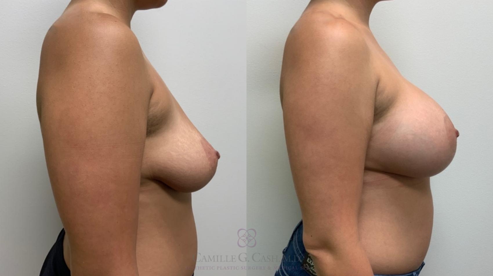 Before & After Breast Augmentation Case 553 Left Side View in Houston, TX