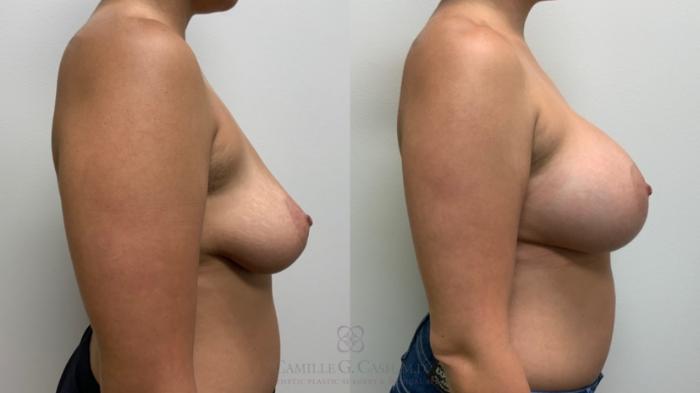 Before & After Breast Augmentation Case 553 Left Side View in Houston, TX