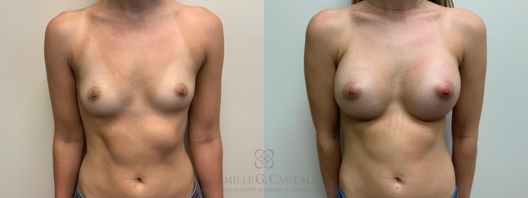 Before & After Breast Augmentation Case 561 Front View in Houston, TX