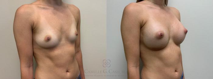 Before & After Breast Augmentation Case 561 Left Oblique View in Houston, TX