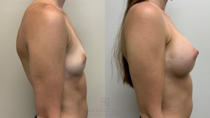 Before & After Breast Augmentation Case 561 Left Side View in Houston, TX