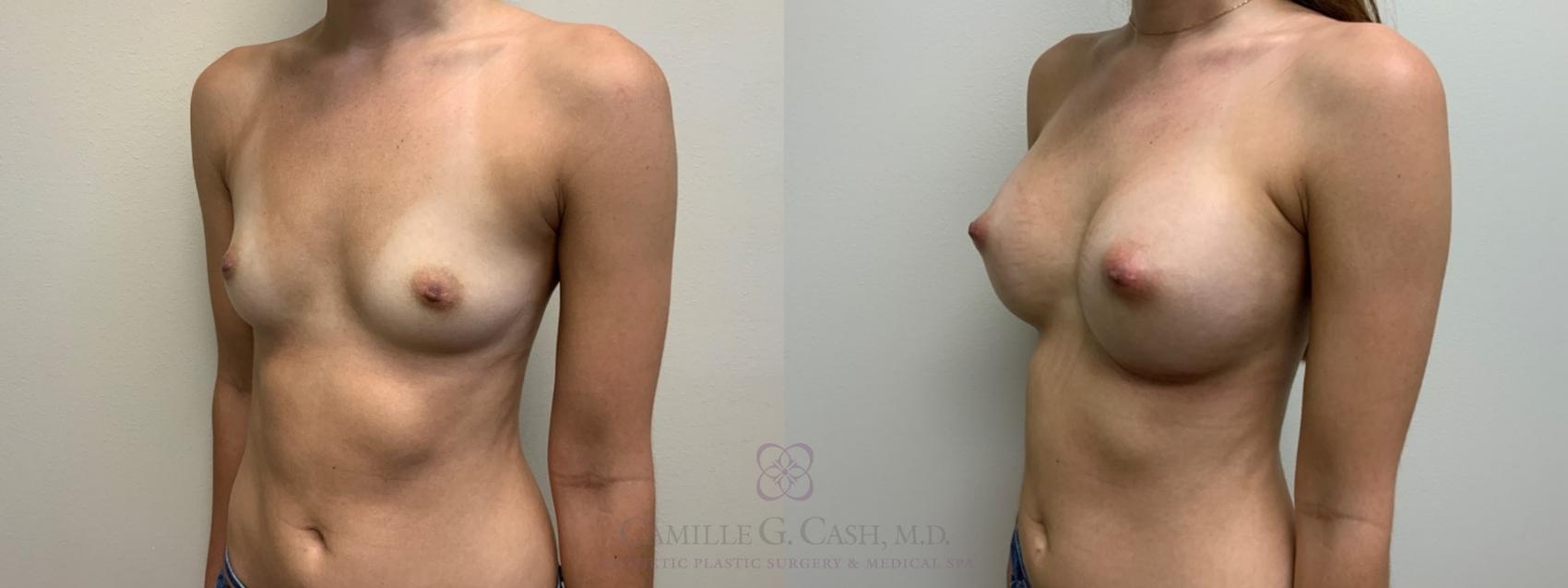 Before & After Breast Augmentation Case 561 Right Oblique View in Houston, TX
