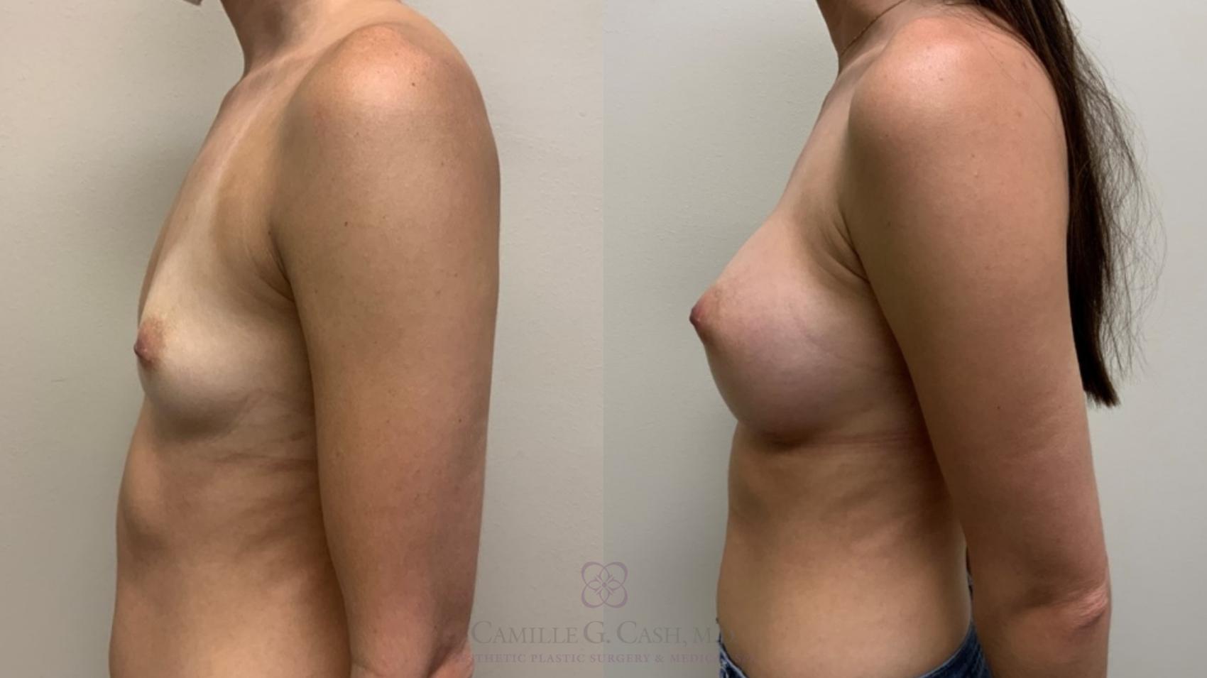 Before & After Breast Augmentation Case 561 Right Side View in Houston, TX