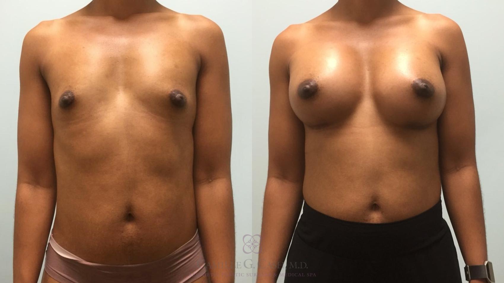 Before & After Breast Augmentation Case 579 Front View in Houston, TX
