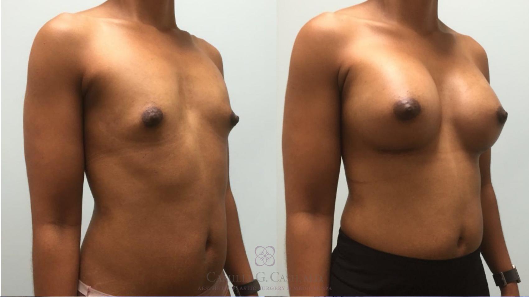 Before & After Breast Augmentation Case 579 Left Oblique View in Houston, TX