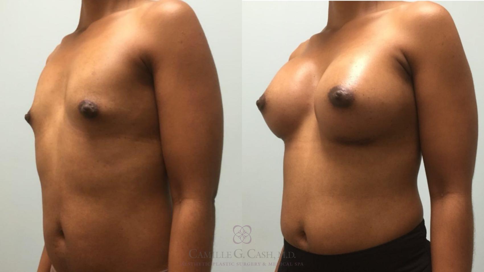 Before & After Breast Augmentation Case 579 Right Oblique View in Houston, TX