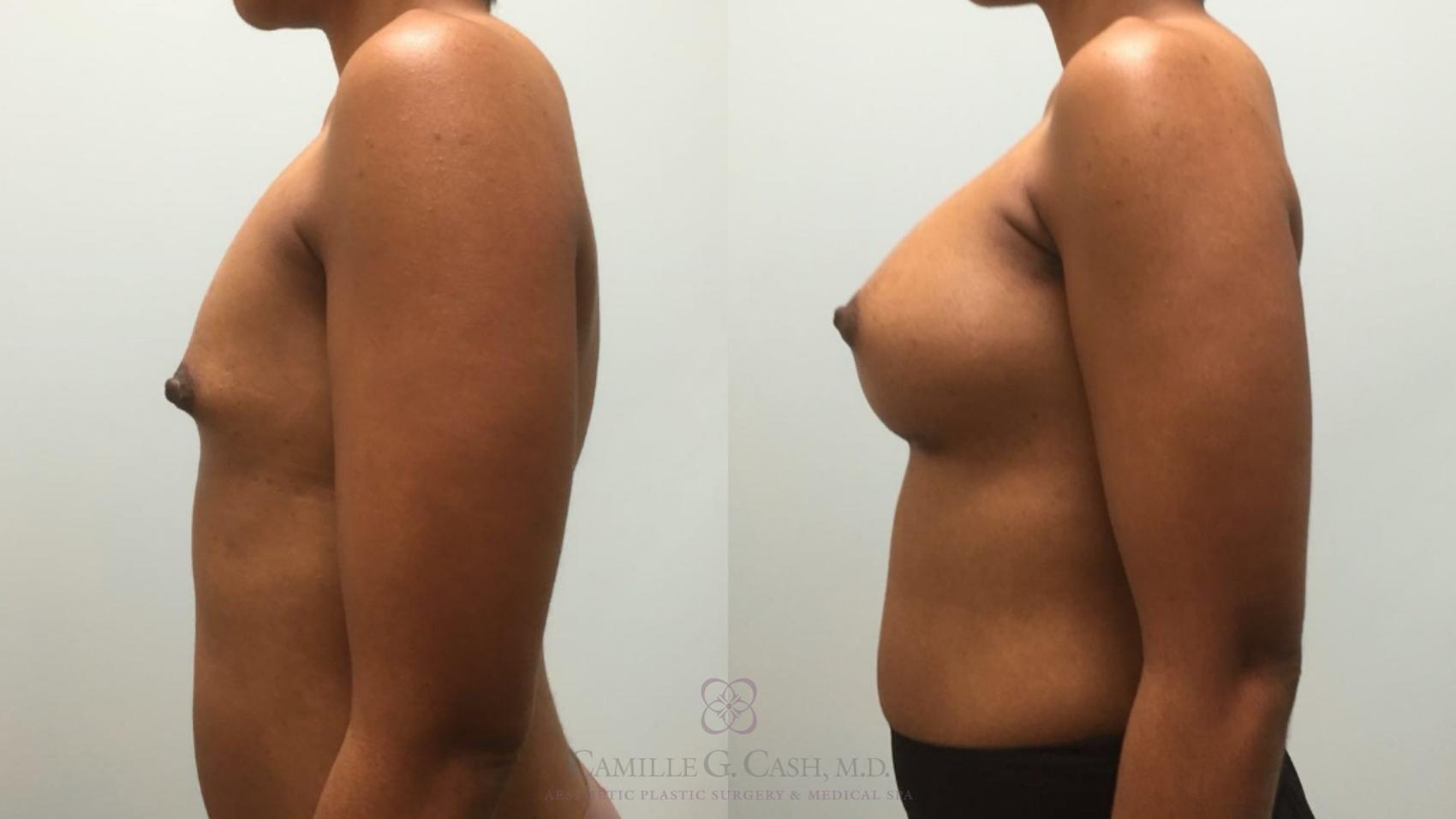 Before & After Breast Augmentation Case 579 Right Side View in Houston, TX